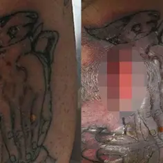 Ropa na tatuażu: Kiedy się niepokoić? Objawy infekcji